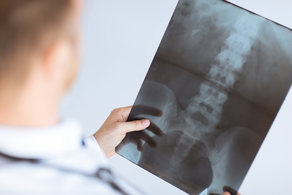 San Diego Spinal Cord Injury Lawyer
