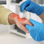 Degrees Of Burns In A California Injury Claim
